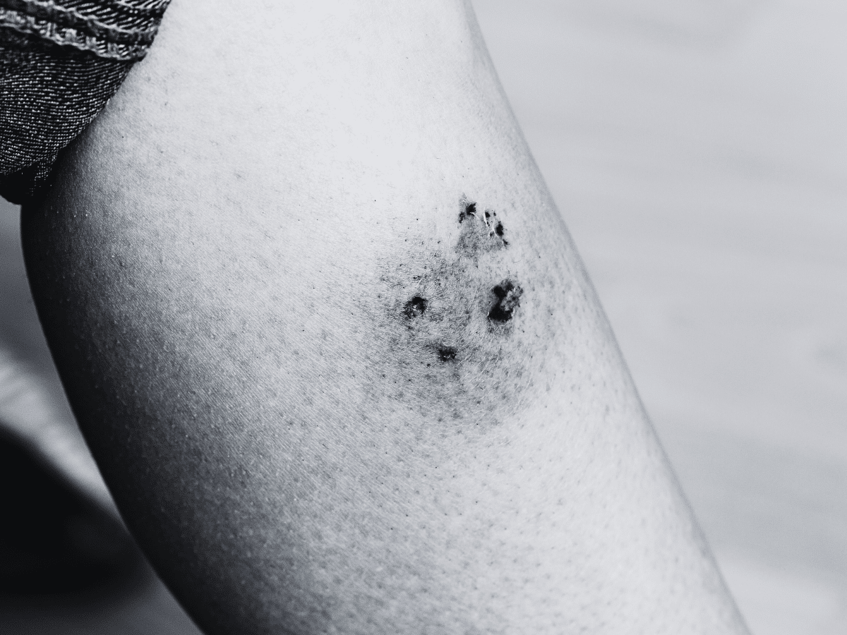 Dog Bite Claim