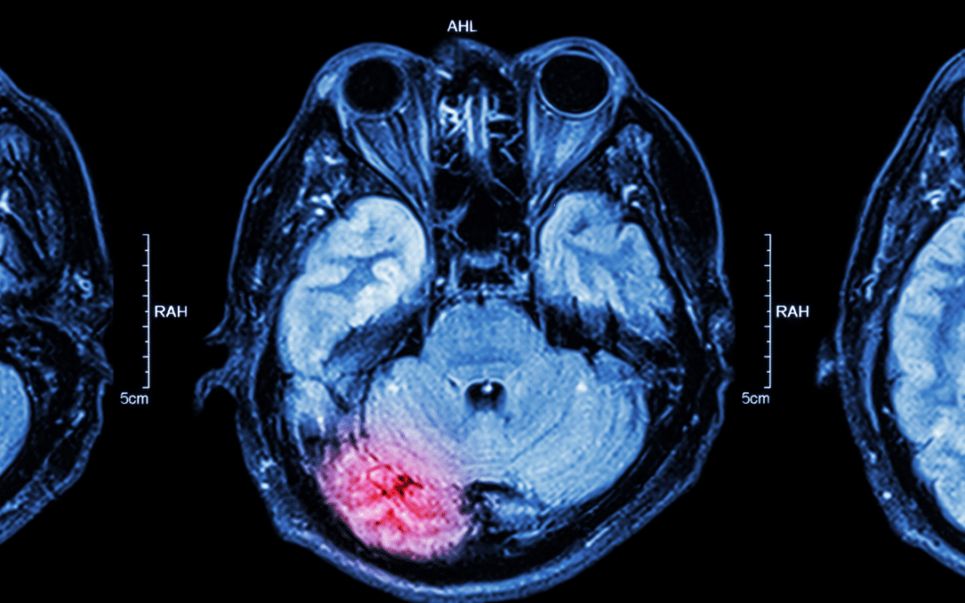 Traumatic Brain Injuries (TBI): The Long-Term Costs of “Invisible” Injuries